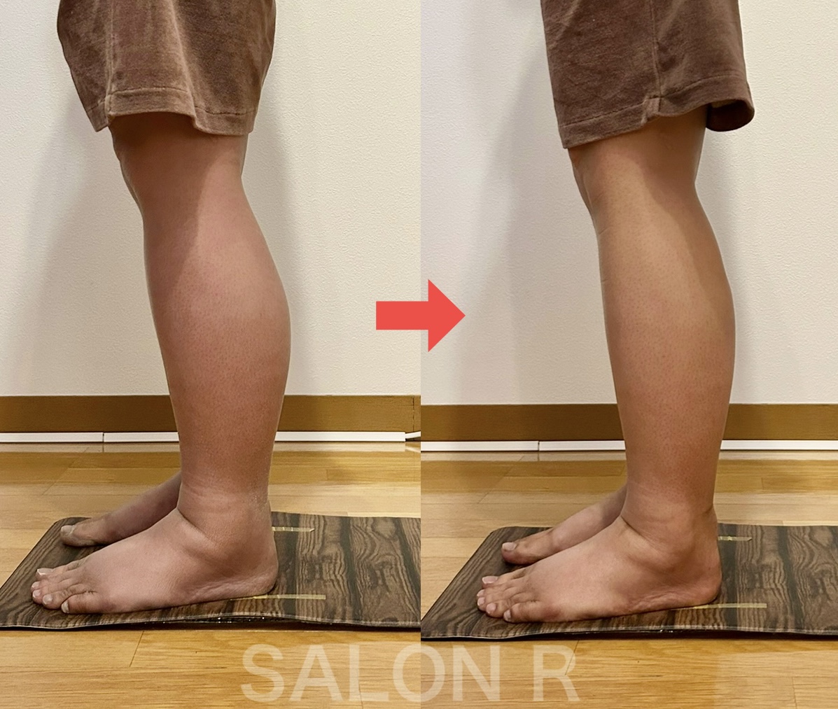 病気による足のむくみ