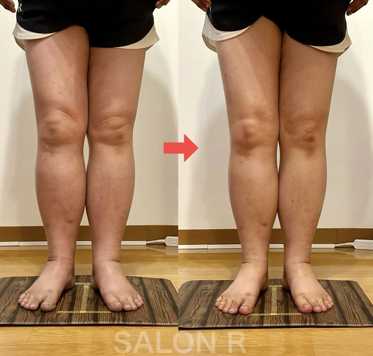 病気による足のむくみ