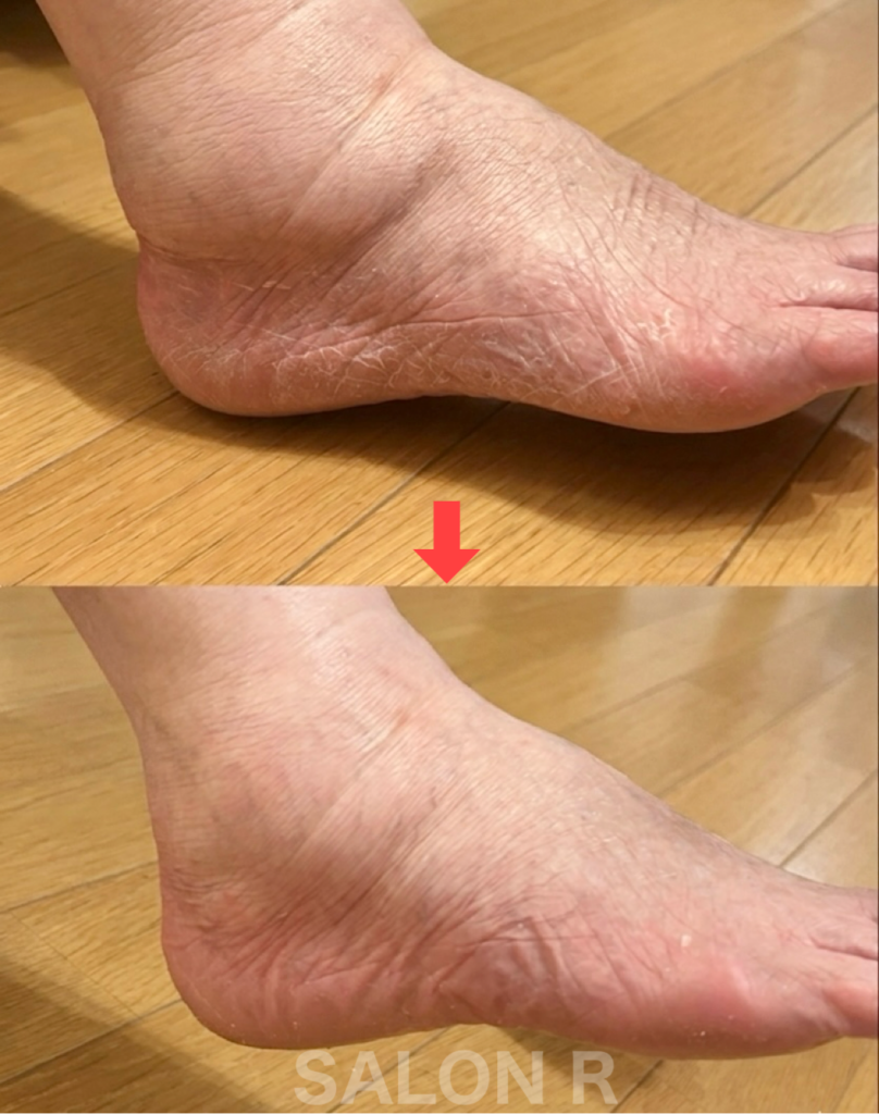 くるぶしのコブむくみ改善/つくばサロンR